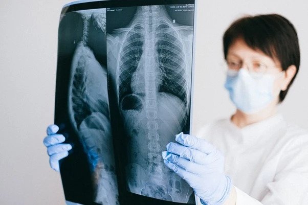 Can CBD Help treat Severe Lung Inflammation in some Coronavirus Survivors?